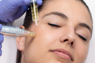 Microneedling with PRP