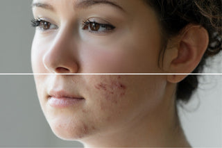 New PhotoRenew Duo Treatment at Sherlase Clinic & Spa