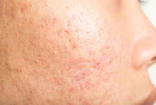 Discover the Best RF Matrix Treatment